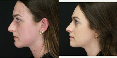 Rhinoplasty before and after photo
