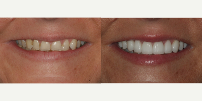 Smile Makeover before and after photo