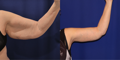 Arm Lift before and after photo
