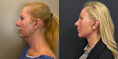 Brow Lift before and after photo