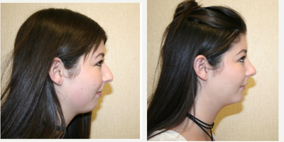 Chin Implant before and after photo