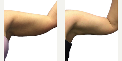 CoolSculpting before and after photo