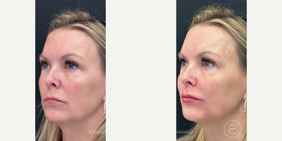 Lip Fillers before and after photo