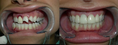 Porcelain Veneers before and after photo