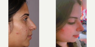 Rhinoplasty before and after photo