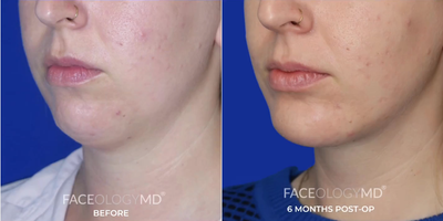Chin Liposuction before and after photo