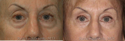 Eyelid Surgery before and after photo