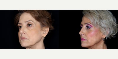 Eyelid Surgery before and after photo