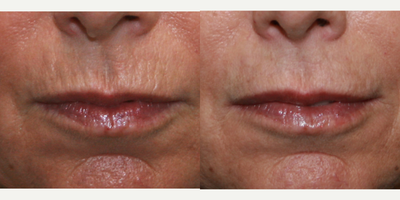 Volbella before and after photo