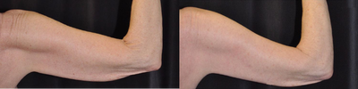 Arm Lift before and after photo