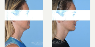 Chin Liposuction before and after photo