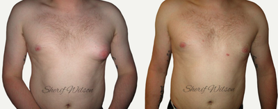 Gynecomastia Surgery before and after photo