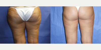Liposuction before and after photo