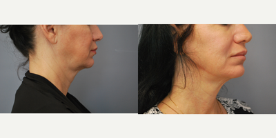 Nonsurgical Neck Lift before and after photo