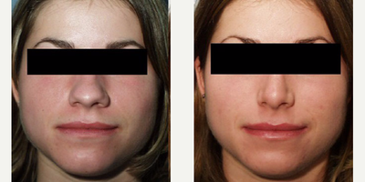Rhinoplasty before and after photo