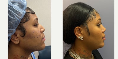 Rhinoplasty before and after photo