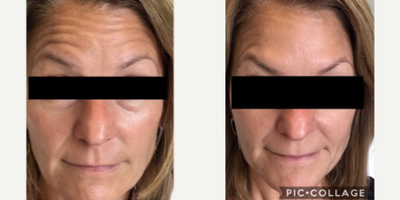 Botox before and after photo