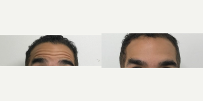 Botox before and after photo