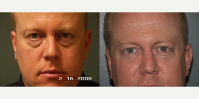 Eyelid Surgery before and after photo