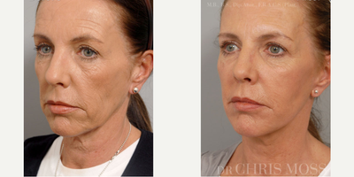 Facelift before and after photo