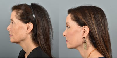 CO2 Laser before and after photo