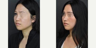 Asian Rhinoplasty before and after photo