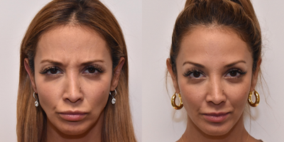 Botox before and after photo