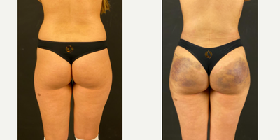 Brazilian Butt Lift before and after photo
