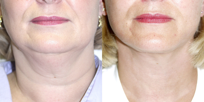 Facelift before and after photo
