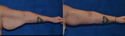 Arm Lift before and after photo