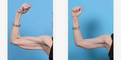 Arm Lift before and after photo