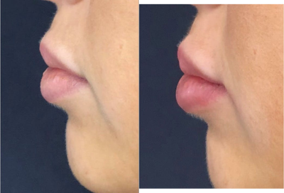 Lip Fillers before and after photo