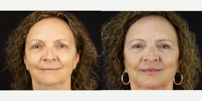 Lip Fillers before and after photo