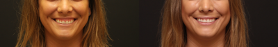 Botox for Gummy Smile before and after photo