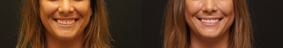 Botox for Gummy Smile before and after photo
