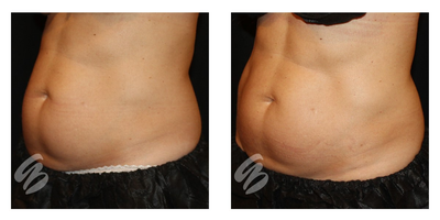 Evolve before and after photo