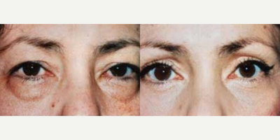 Eyelid Surgery before and after photo
