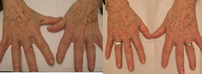 IPL before and after photo