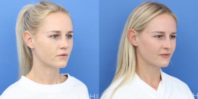 Rhinoplasty before and after photo