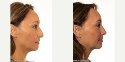 Rhinoplasty before and after photo