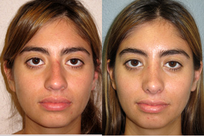 Rhinoplasty before and after photo
