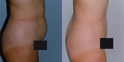 Tummy Tuck before and after photo