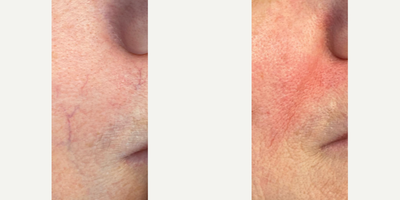 CO2 Laser before and after photo