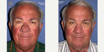 CO2 Laser before and after photo