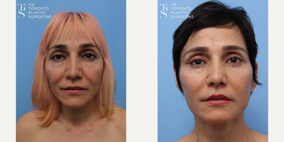 Facelift before and after photo