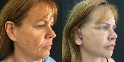 Facelift before and after photo