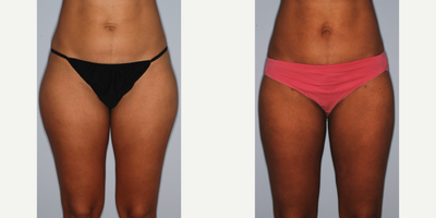 Laser Liposuction before and after photo