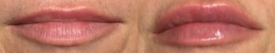 Lip Fillers before and after photo
