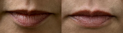 Lip Fillers before and after photo
