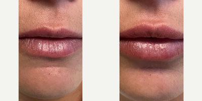Lip Fillers before and after photo
